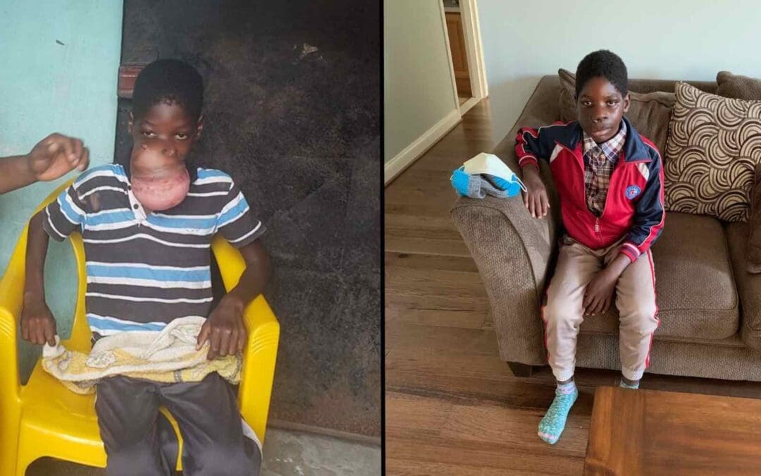 Baptists Help Liberian Boy Receive Life-Changing Surgery